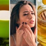 Qué productos naturales puedo utilizar para combatir el acné